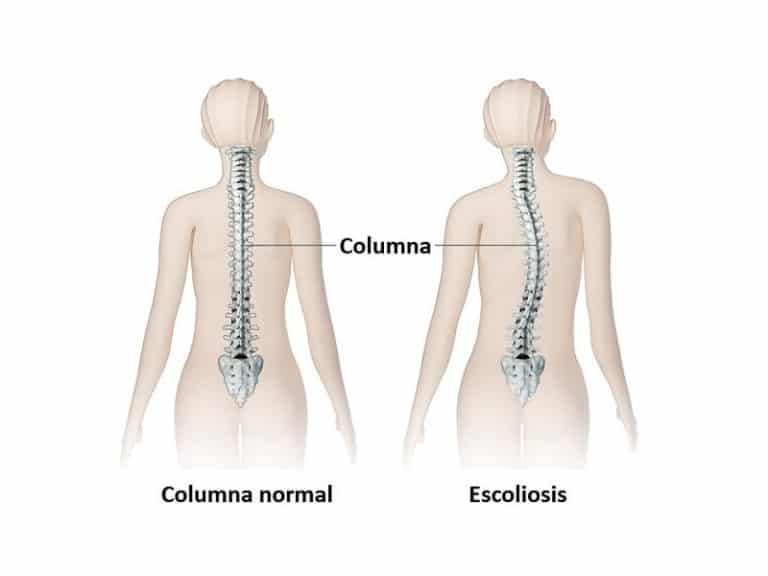 ¿qué Es La Escoliosis Conoce Los Síntomas Y Tratamientos Clinica Fixenemk 0093